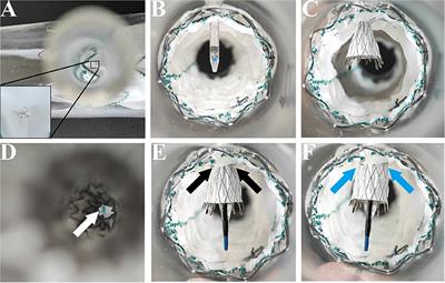 The Mini-Cross Prefenestration for Endovascular Repair of Aortic Arch Pathologies